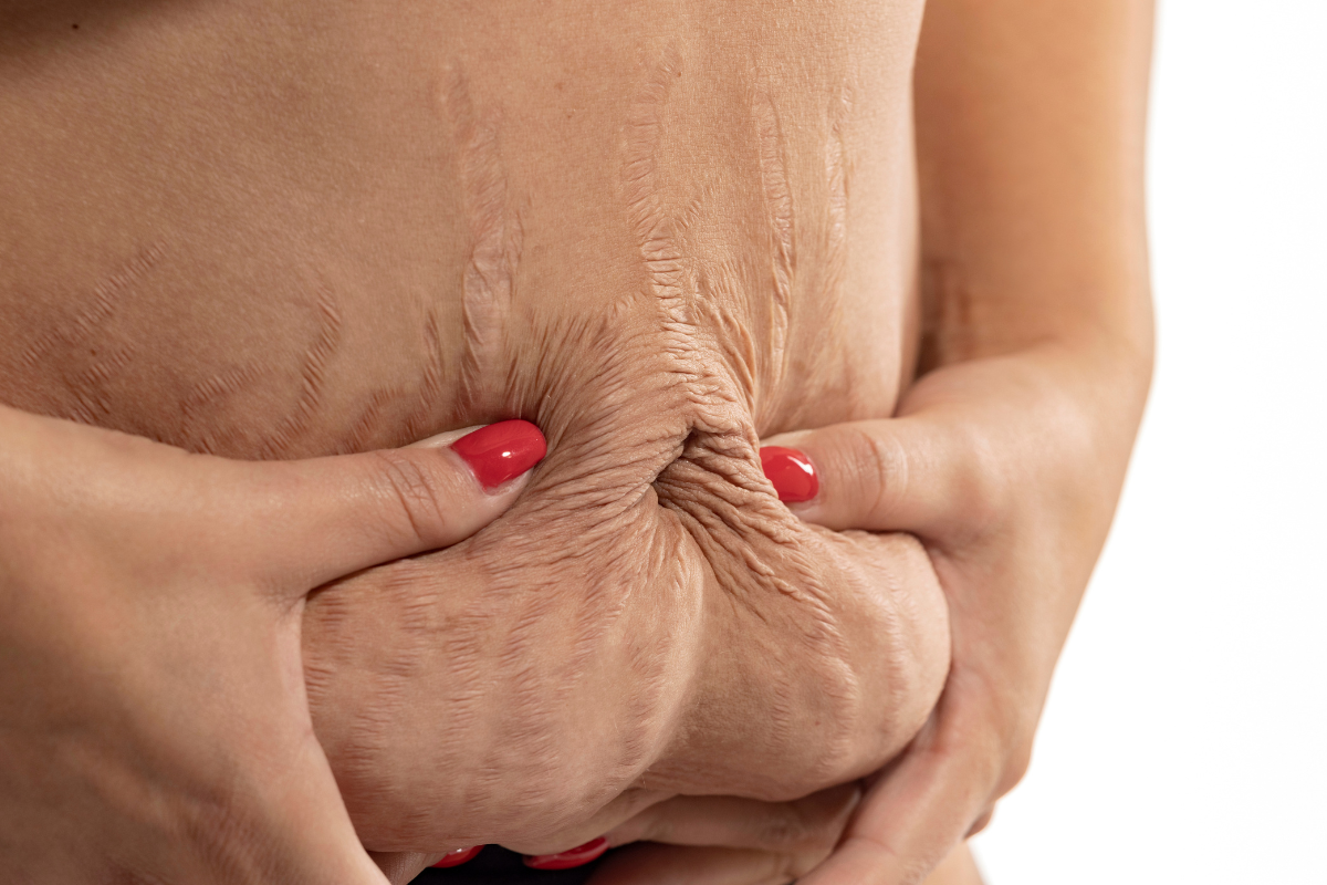 Kollagen vid lös hud & slapp hud collagen loose skin celloptimum