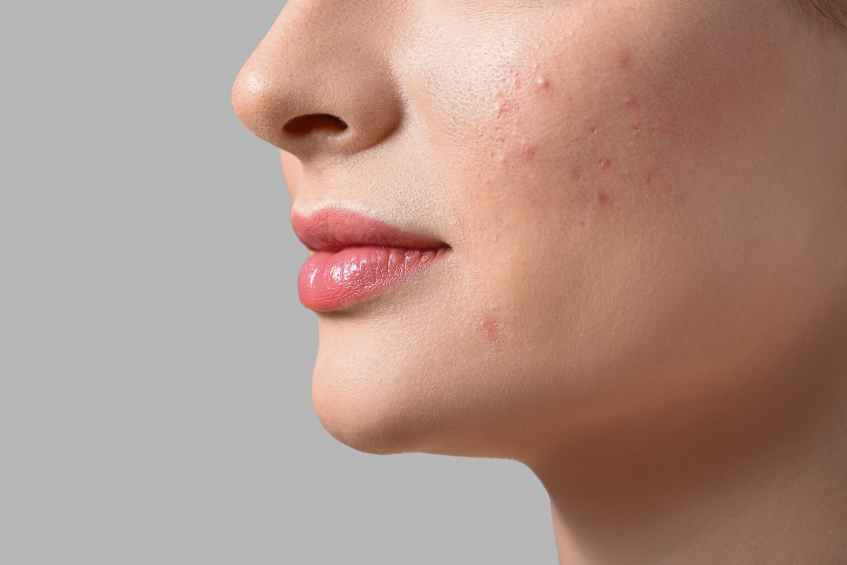 Kollagen - läckande tarm och akne collagen leaky gut acne celloptimum