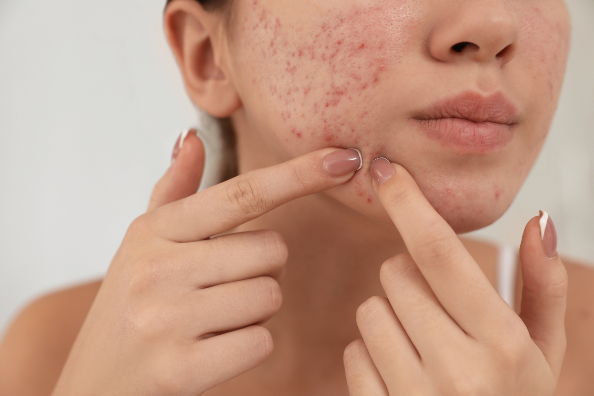 akne kosttillskott collagen kollagen celloptimum acne supplements