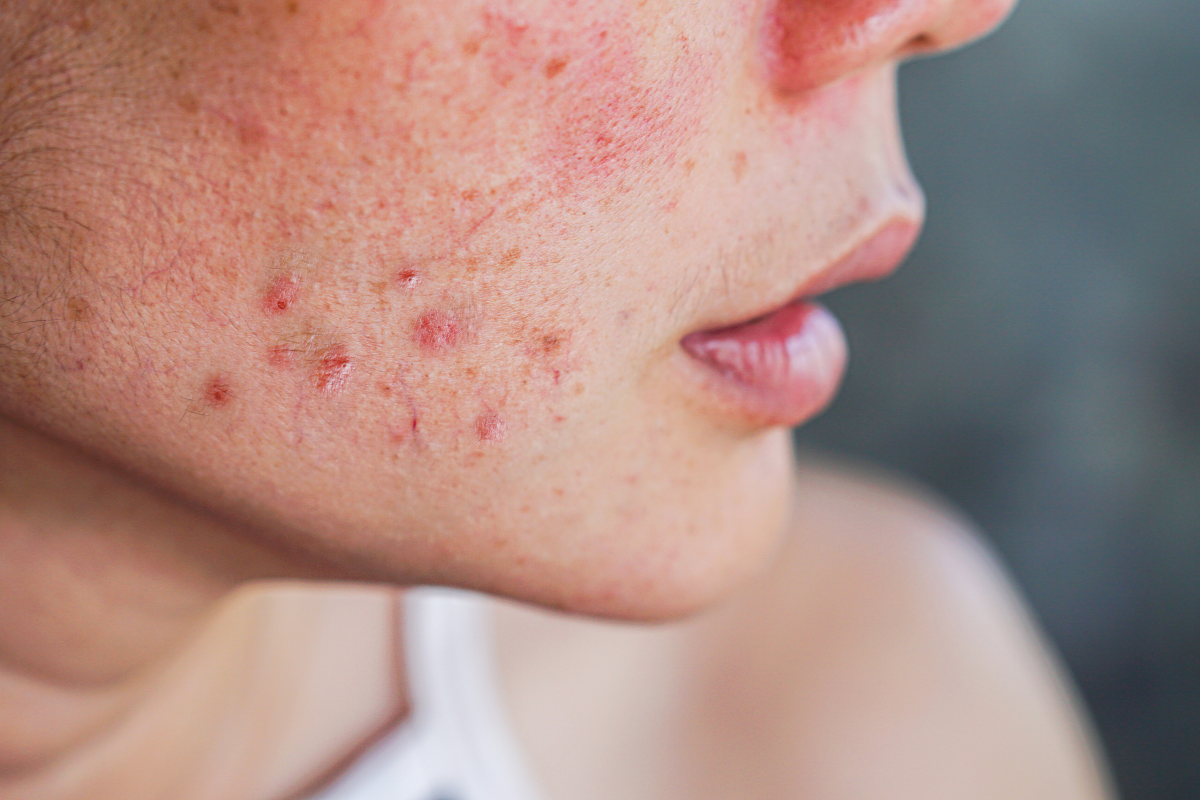 Kollagen vid akne & inflammation collagen acne inflammation skin celloptimum hud