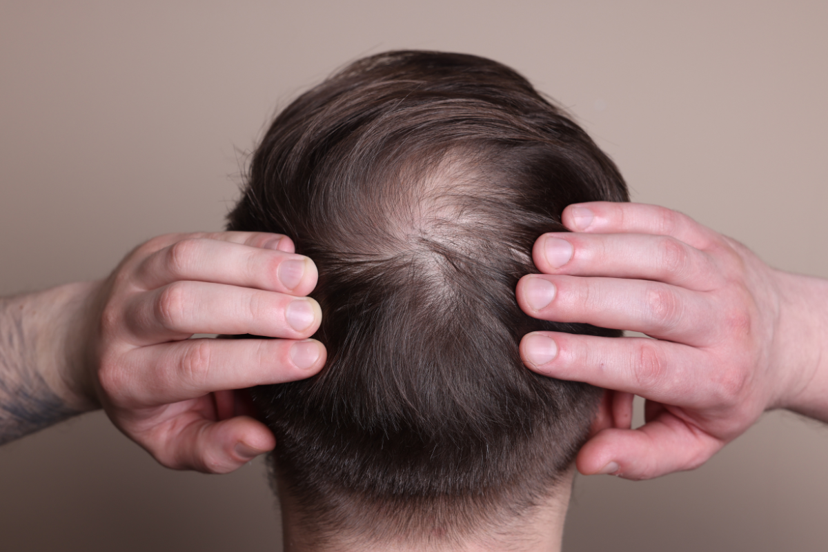 hair loss håravfall celloptimum kollagen collagen